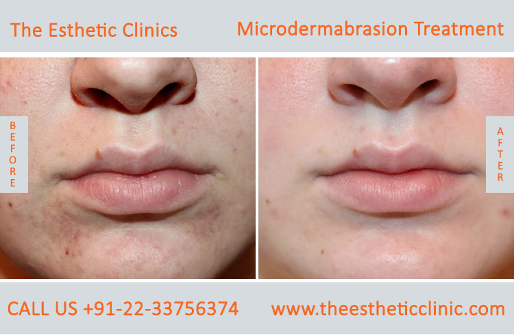 Microdermabrasion Dermabrasion Treatment before after photos in mumbai india (5)
